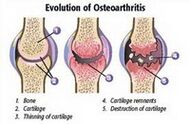 Mga yugto sa Arthrosis