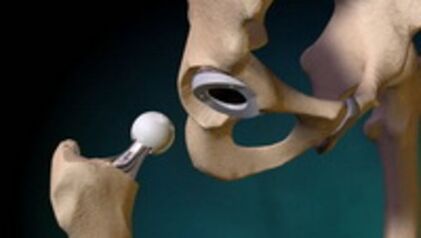 Problema alang sa hip joint