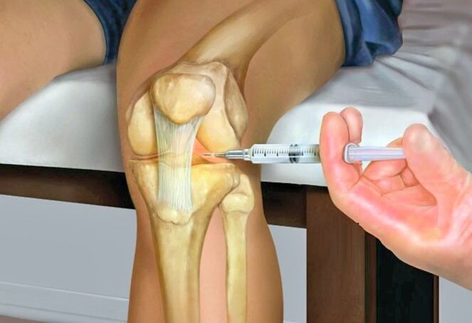Pagtambal sa arthrosis sa tuhod nga hiniusa