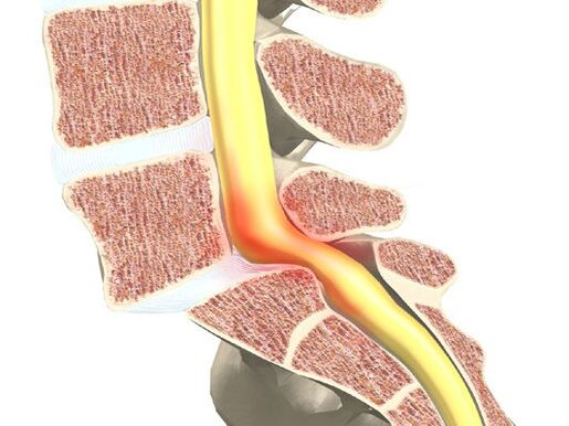 Segment sa motor-motor alang sa Osteochondrosis