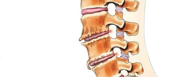 Spondylosis - pagkaguba sa mga lutahan sa intervertebral