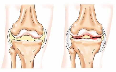 Himsog nga Joint ug Arthrosis