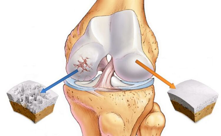 Pag-usab sa Arthrosis