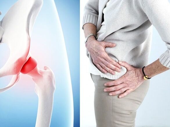 Mga Sintomas sa Arthrosis sa Hip Joint