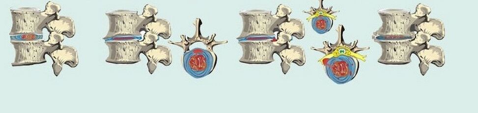 Ang lainlaing mga yugto sa thoracic osteochondrosis