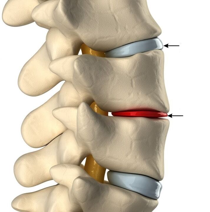 kalainan tali sa usa ka himsog nga disc ug usa ka disc nga adunay osteochondrosis