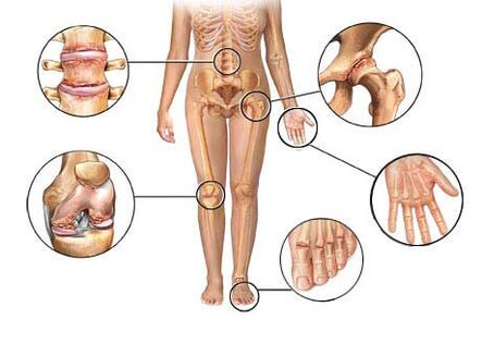 Ang Arthrosis nakaapekto sa lainlaing mga lutahan