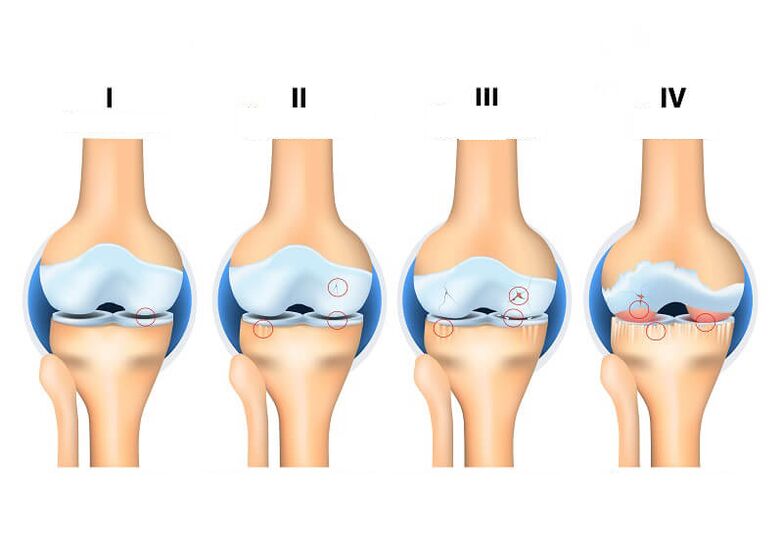 Mga yugto sa Joint Arthrosis