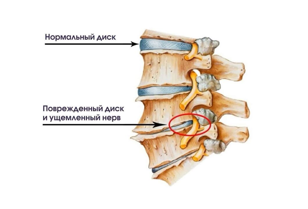 Sintomas sa cervical osteochondrosis