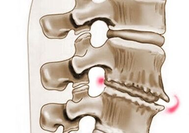 kadaot sa vertebrae sa thoracic osteochondrosis