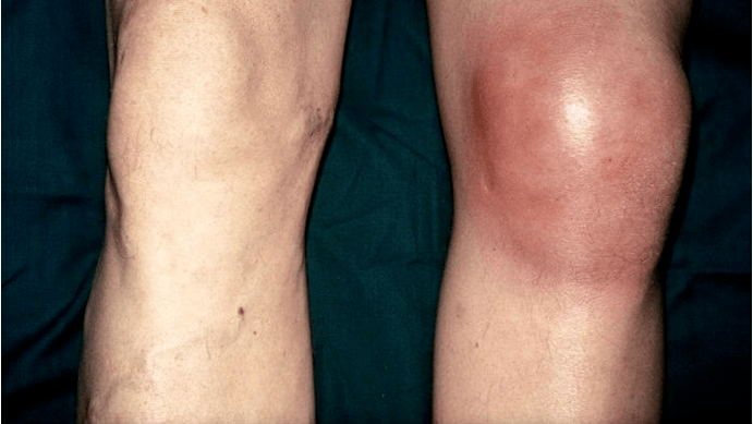 arthrosis ug arthritis